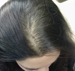 Alopecia example