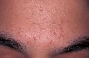 Acne example