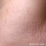 Stretch marks